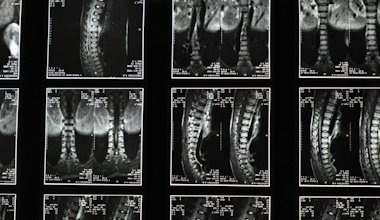 Osteoporozės simptomai – kaip juos atpažinti laiku